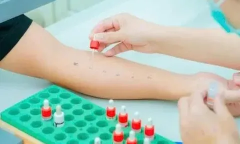 Nguy cơ khó lường từ dị ứng thuốc và thức ăn