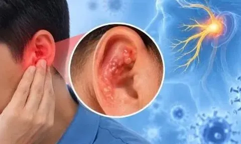 Liệt mặt sau đau quanh tai, nổi mụn nước: Cẩn trọng với Ramsay Hunt