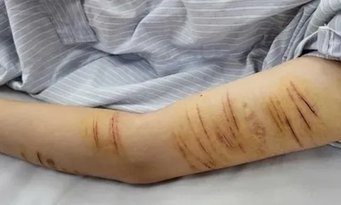 Trẻ vị thành niên và hành vi tự gây thương tích: Đừng để mạng xã hội thay thế kết nối gia đình